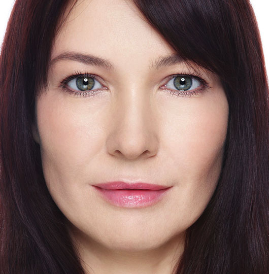 Chemical-Peel-Treatment-Ultimo